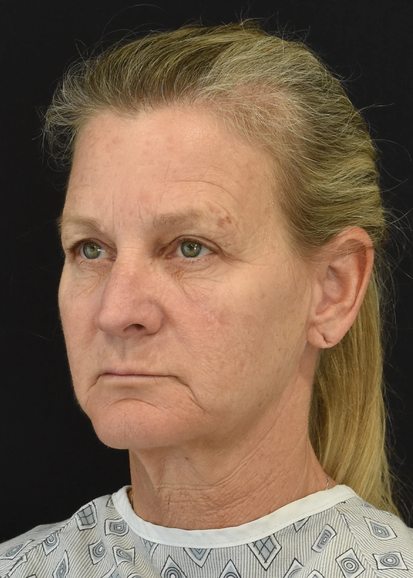 Deep Plane Facelift Patient 34 Set 1 Before